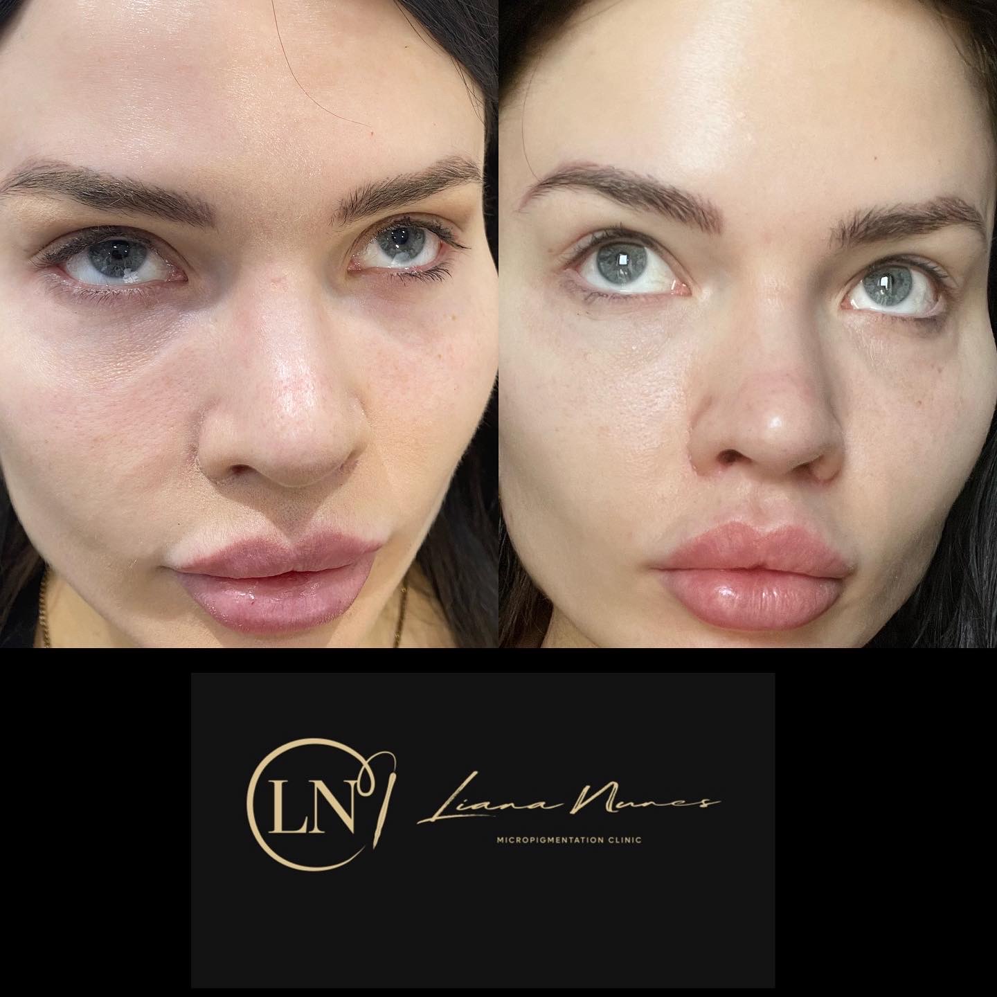 dark-circles-before-after-1 Dark Circles Before & After