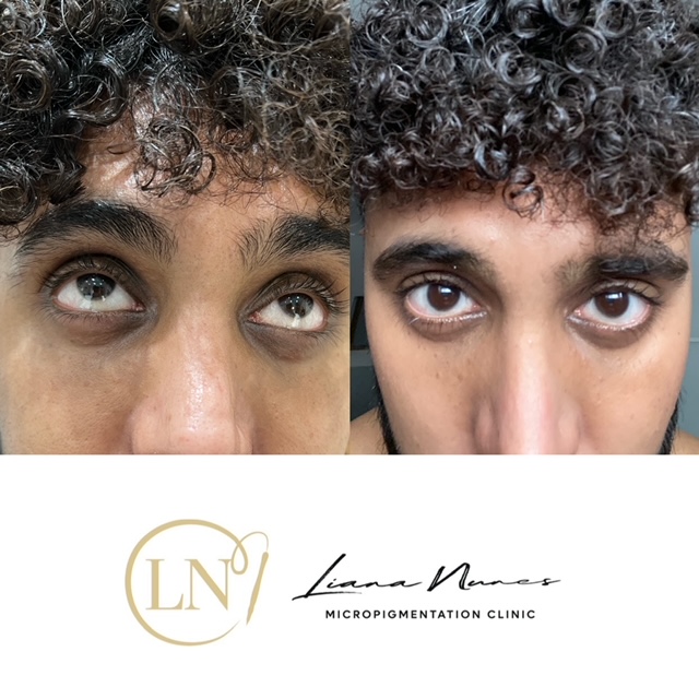 dark-circles-cemouflage-before-after-march-2 dark-circles-cemouflage-before-after-march-2