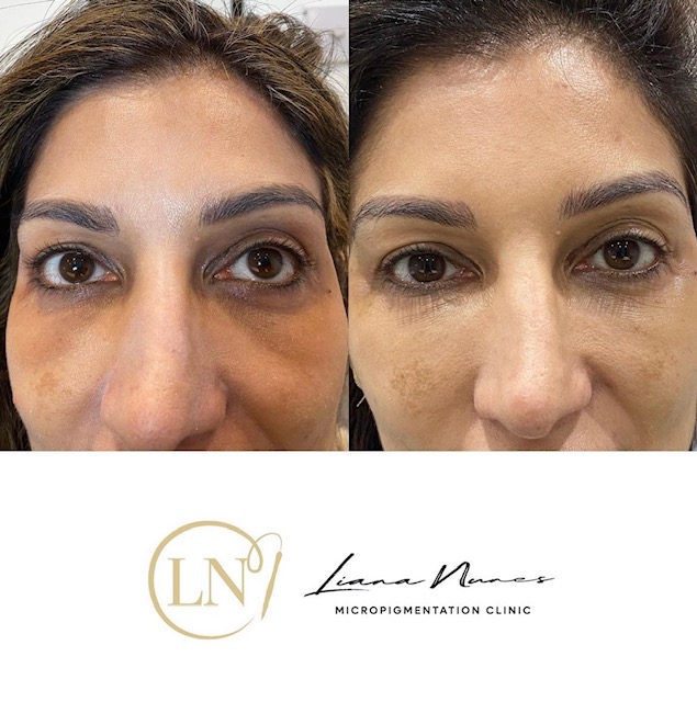 before-after-dark-circles Before and After