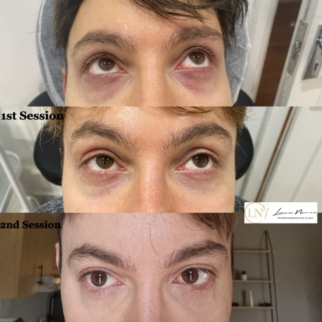 dark-circles-only-two-sessions 2 Sessions