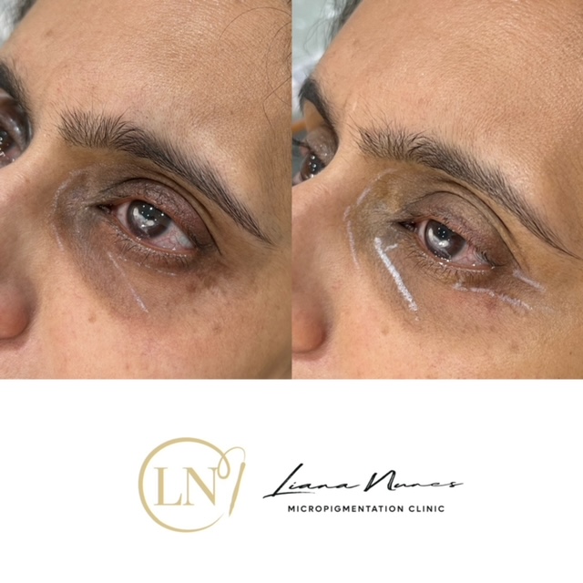dark circles camouflage tattooing-3-session-2 3 Sessions